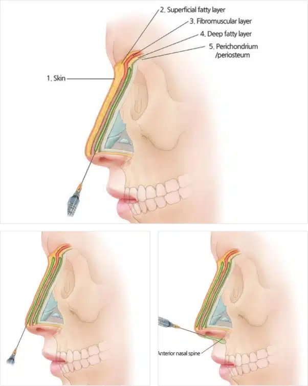 Bao nhiêu tuổi thì được nâng mũi, độ tuổi lý tưởng nhất 14 Nose Fillers and Nose Threads Singapore | Treatment Details and Pricing