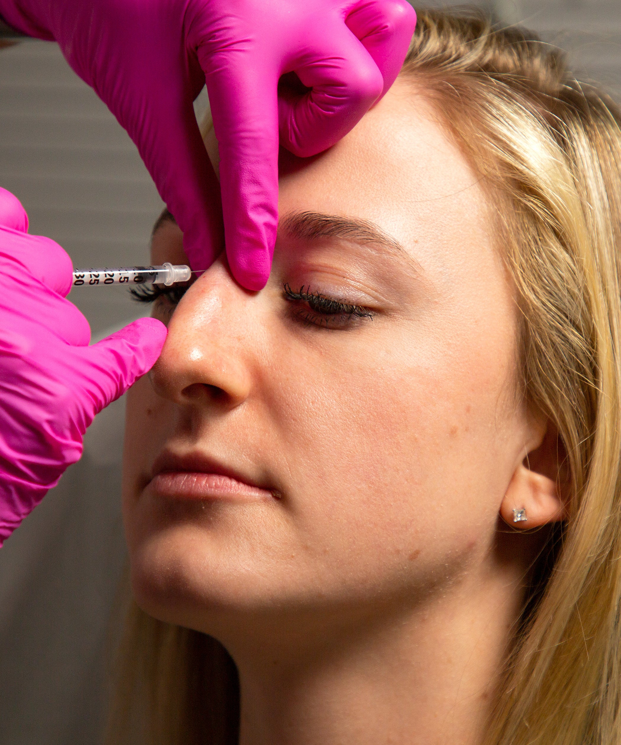 Chi phí nâng mũi bán cấu trúc bao nhiêu, bảng giá 2026 16 Nose Job Tinkerbell Tip Lift Liquid Rhinoplasty Review