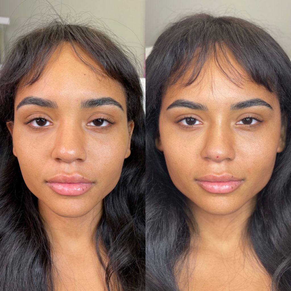 Chi phí thu gọn đầu mũi và cánh mũi, bảng giá mới 16 Expert PDO Non-Surgical Nose Job in Clearwater, Florida