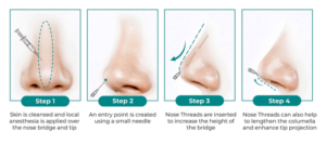 Nose Lift and Reshaping-Refining Your Profile