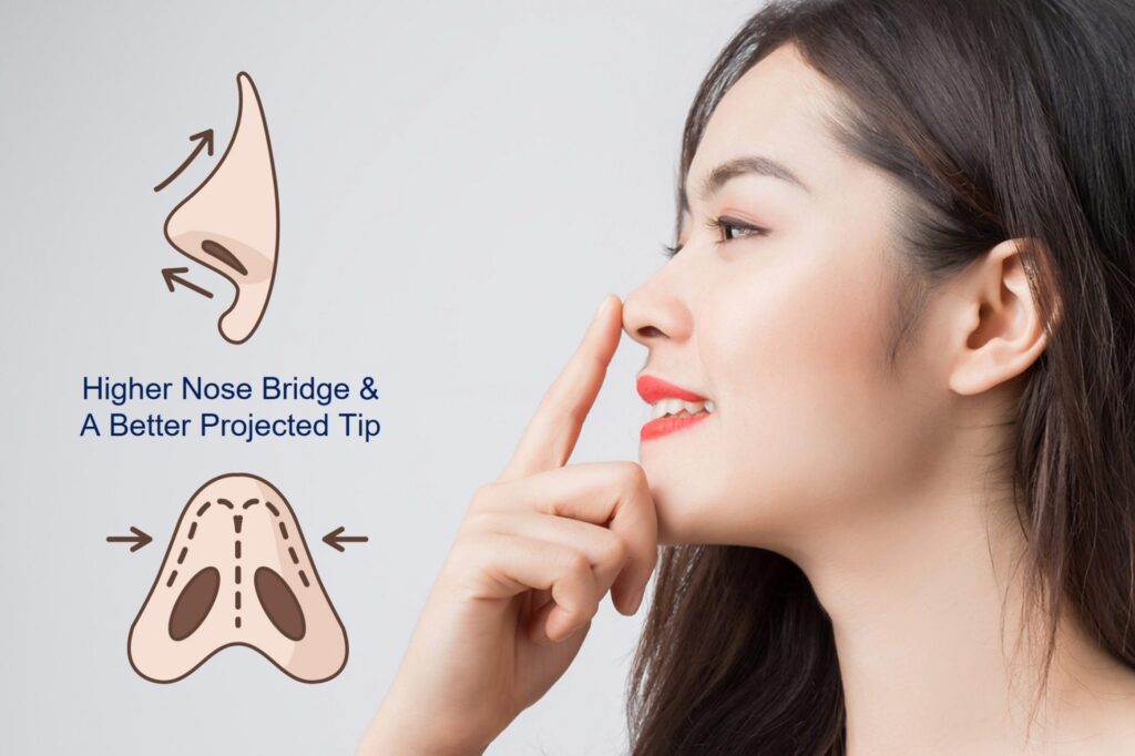 Công nghệ 3D mô phỏng mũi, xem trước kết quả chuẩn xác 15 Why choose Hiko Nose thread lift? - Hollywood Medspa