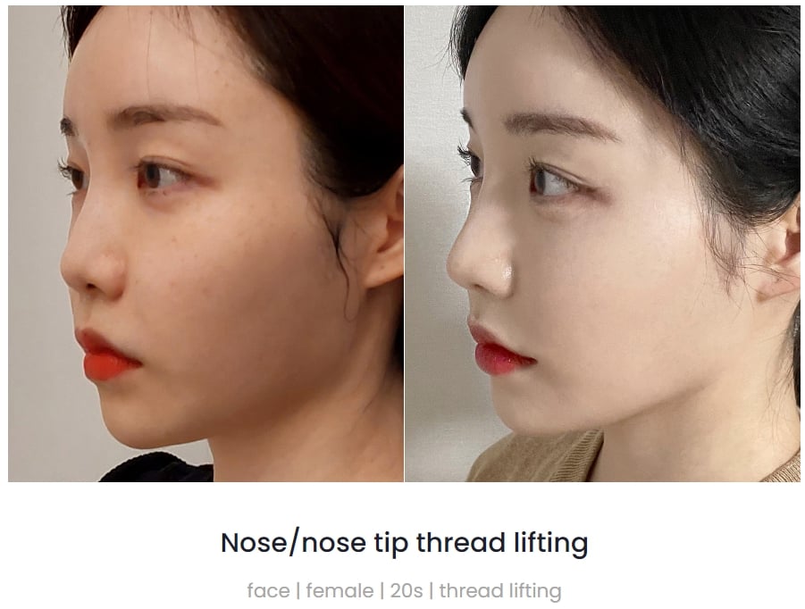 Khi nào cần nâng mũi cấu trúc, tư vấn từ chuyên gia 14 Nose Thread Lift in Korea | What Is Nose Thread Lifting? How Much Does It Cost? And Which Clinic?