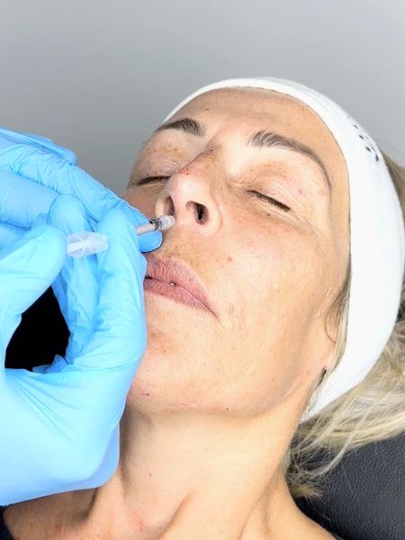 Mũi bị đỏ đầu và lộ sóng, nguyên nhân cách khắc phục 9 Nose Tip Lift Botox Training | Derma Institute