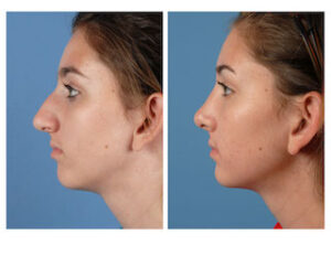 Rhinoplasty: What to expect before and after a