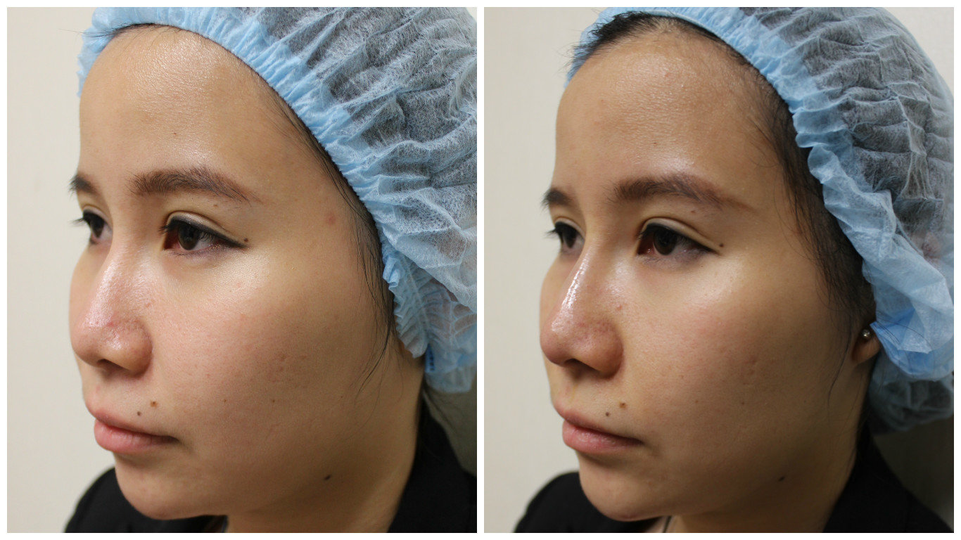 Nâng mũi bán cấu trúc sửa được mũi hỏng không, tư vấn 14 What are Nose Thread lifts? - SG BEAUTY BLOG