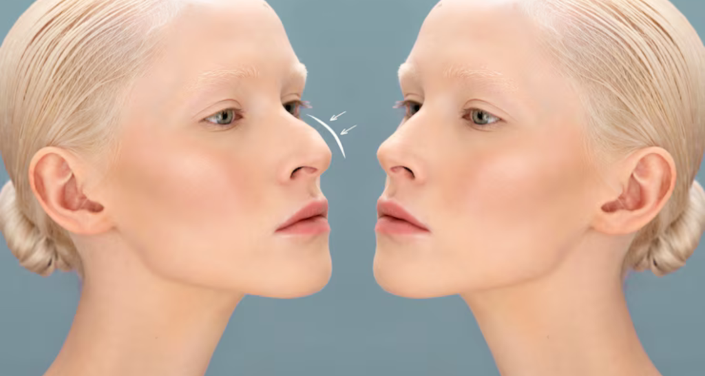 Nâng mũi bán cấu trúc sửa được mũi hỏng không, tư vấn 9 Nose Thread Lift: Results Timeline and What to Expect