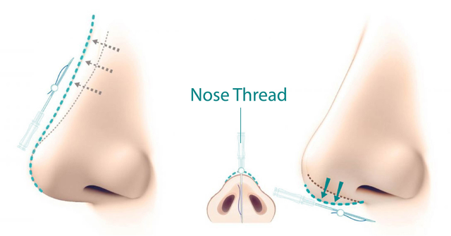 Nâng mũi bán cấu trúc là gì, ưu điểm và sự khác biệt 11 Nose Lift and Reshaping-Refining Your Profile