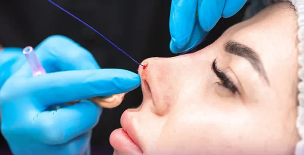 Nâng mũi bán cấu trúc là gì, ưu điểm và sự khác biệt 15 Nose Thread Lift | Non-Surgical Nose Reshaping & Contouring