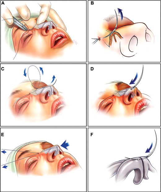 Nâng mũi bán cấu trúc là gì, ưu điểm và sự khác biệt 12 Minimally Invasive Nose Reshaping Guide | Mr Tunç Tiryaki