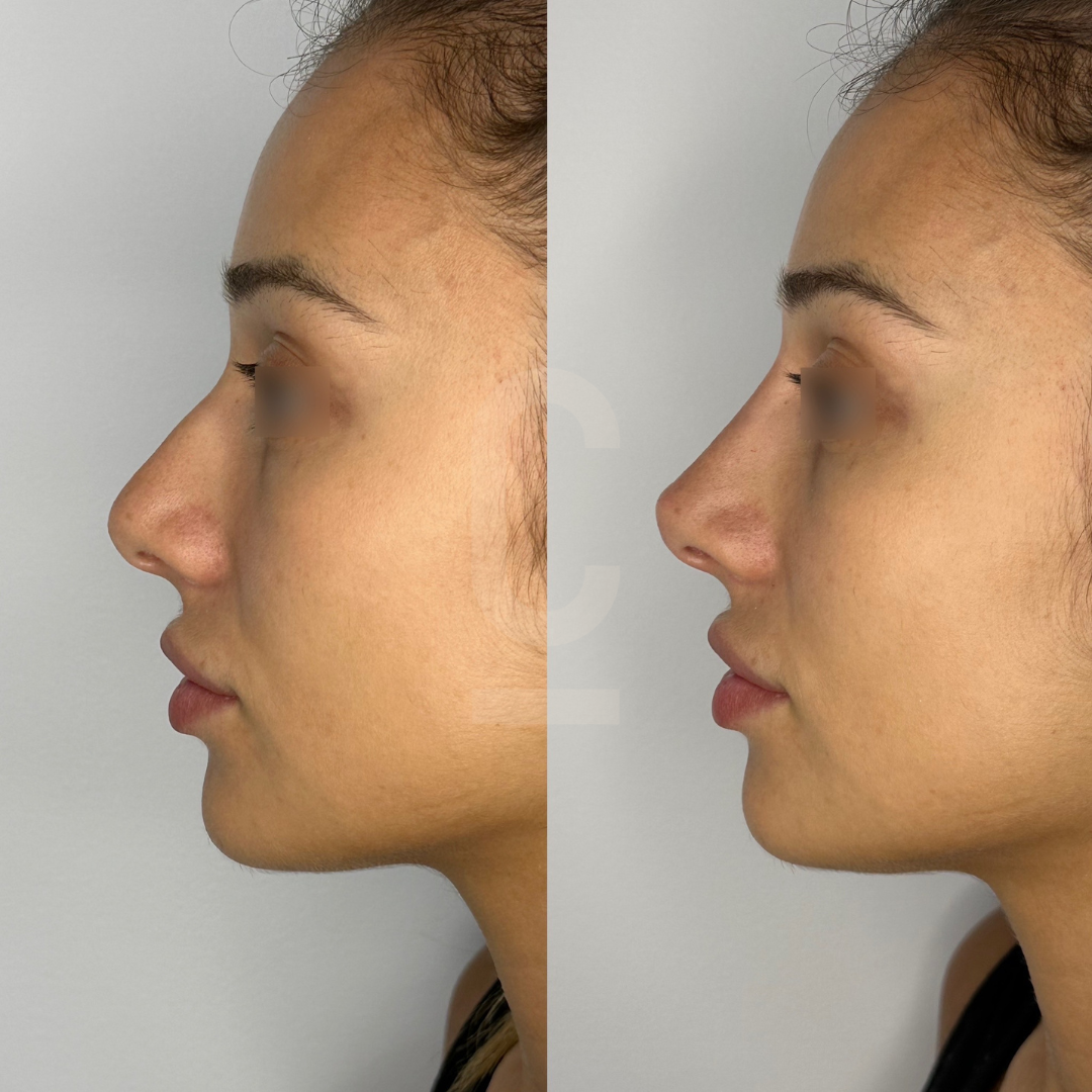 Nâng mũi bán cấu trúc sụn tai, tạo dáng mũi tự nhiên 10 Non-Surgical Nose Jobs & Rhinoplasty Treatments | Cosmetic Connection