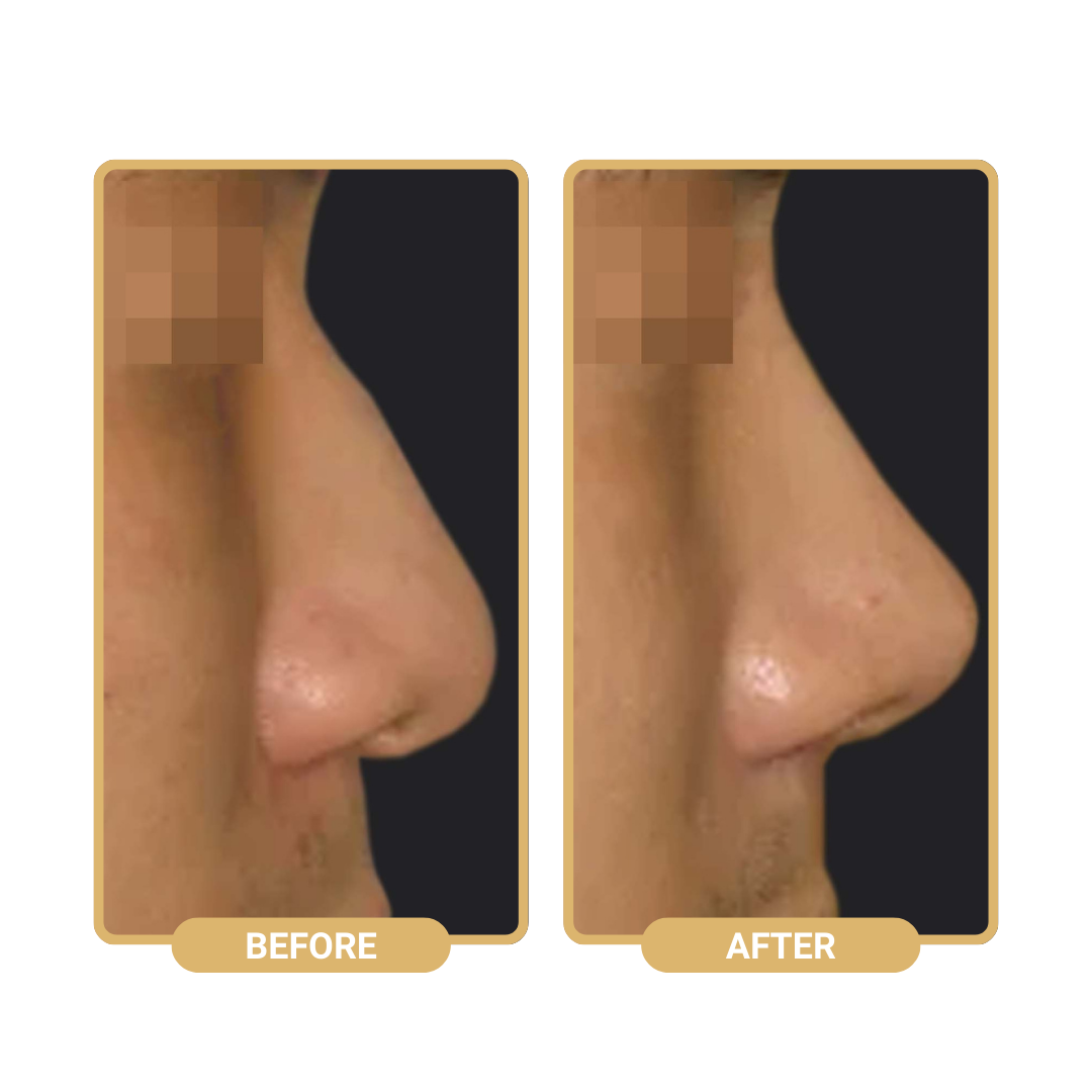 Nâng mũi bán cấu trúc sụn tai, tạo dáng mũi tự nhiên 13 Non-Surgical Nose Augmentation: Understanding the Nose Thread - NextMed Clinic