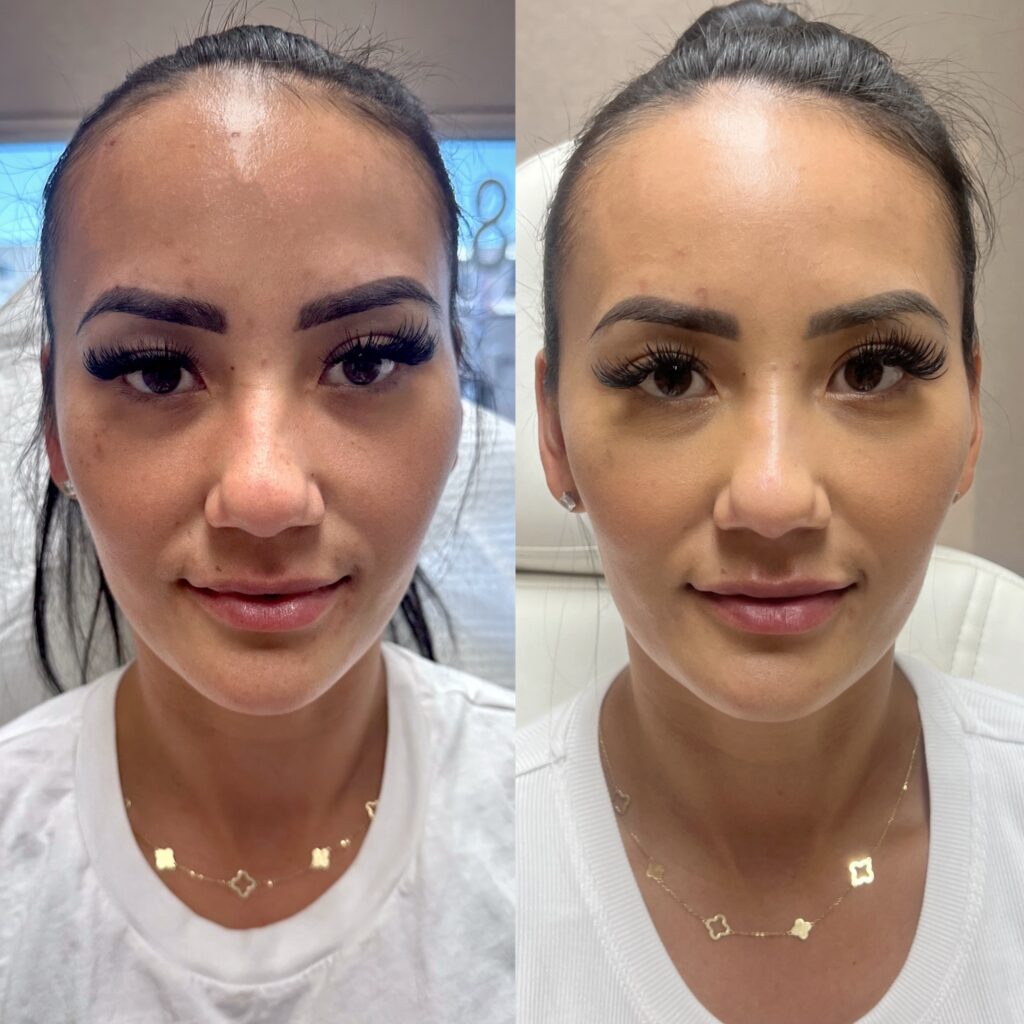 Nâng mũi bao lâu được trang điểm, tư vấn từ chuyên gia 14 The nose thread lift as the new nonsurgical Rhinoplasty - Hush LA Medspa