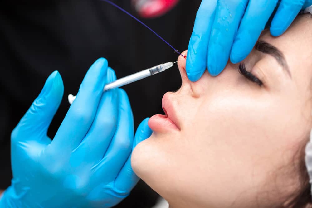 Nâng mũi cấu trúc có phá tướng, dáng mũi hợp phong thủy 17 The nose thread lift as the new nonsurgical Rhinoplasty - Hush LA Medspa