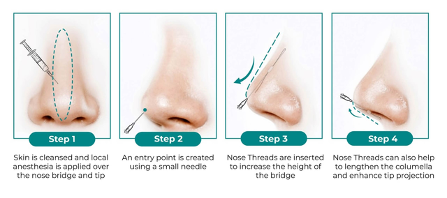 Top các loại nâng mũi đẹp và an toàn nhất hiện nay 10 Nose Lift and Reshaping-Refining Your Profile