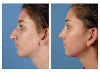 Nâng mũi có ảnh hưởng đến viêm xoang không, giải đáp 12 Rhinoplasty: What to expect before and after a 'nose job' | Plastic Surgery | UT Southwestern Medical Center