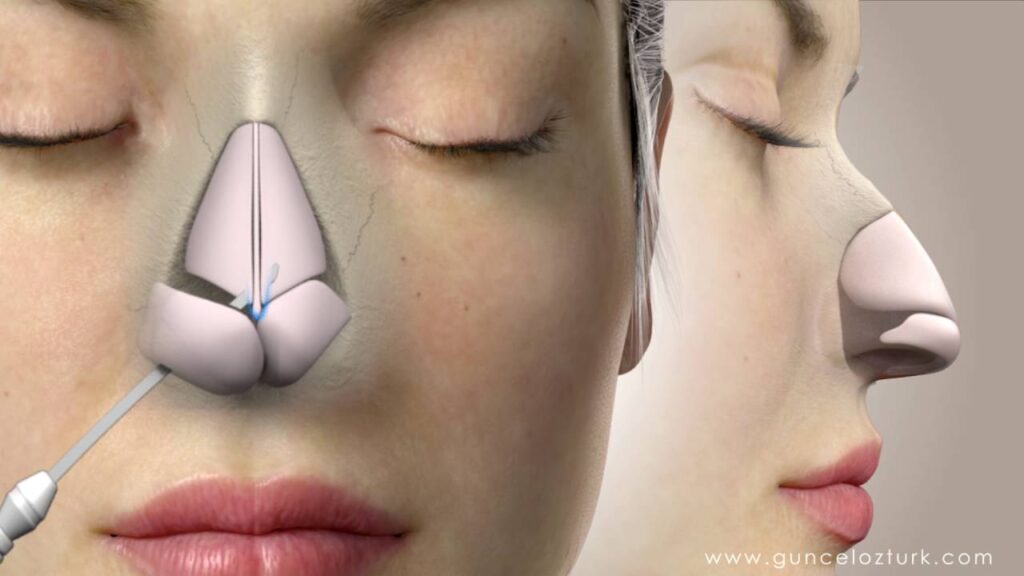 Nâng mũi có ảnh hưởng đến viêm xoang không, giải đáp 9 Rhinoplasty (Nose Job) Video Animation - Assoc.Prof.Dr. Guncel Ozturk, MD - #DRGO