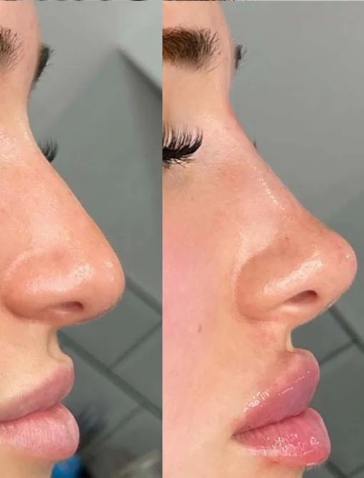 Nâng mũi kiêng ăn gì, chế độ dinh dưỡng giúp nhanh lành 9 Lifting del Naso in Albania - Queen Clinic a Tirana 2026