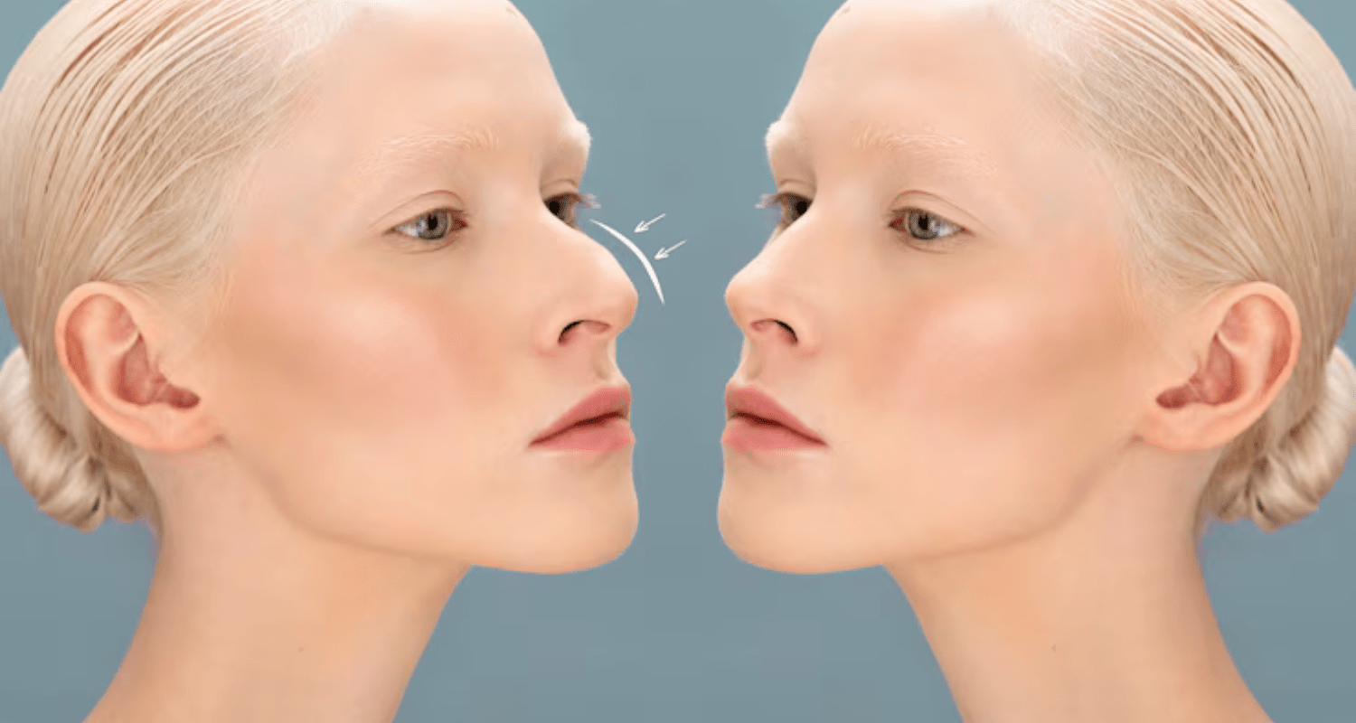 Nâng mũi kiêng ăn gì, chế độ dinh dưỡng giúp nhanh lành 16 Nose Thread Lift: Results Timeline and What to Expect