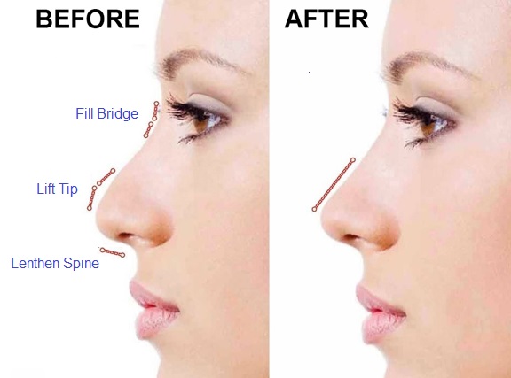 Top các loại nâng mũi đẹp và an toàn nhất hiện nay 12 Non Surgical Nose Job - Castleknock Cosmetic Clinic