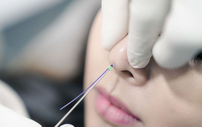 Nâng mũi xong có được đeo kính không, tư vấn chi tiết 12 PCL Nose Thread Lift - Amoa 640