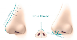 Nose Lift and Reshaping-Refining Your Profile