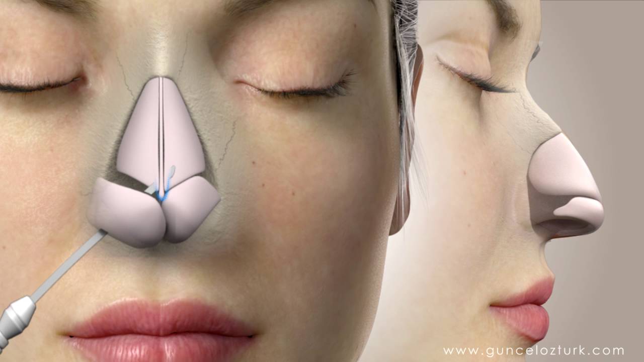 Nguyên nhân và cách xử lý nâng mũi bị nhiễm trùng an toàn 17 Rhinoplasty (Nose Job) Video Animation - Assoc.Prof.Dr. Guncel Ozturk, MD - #DRGO