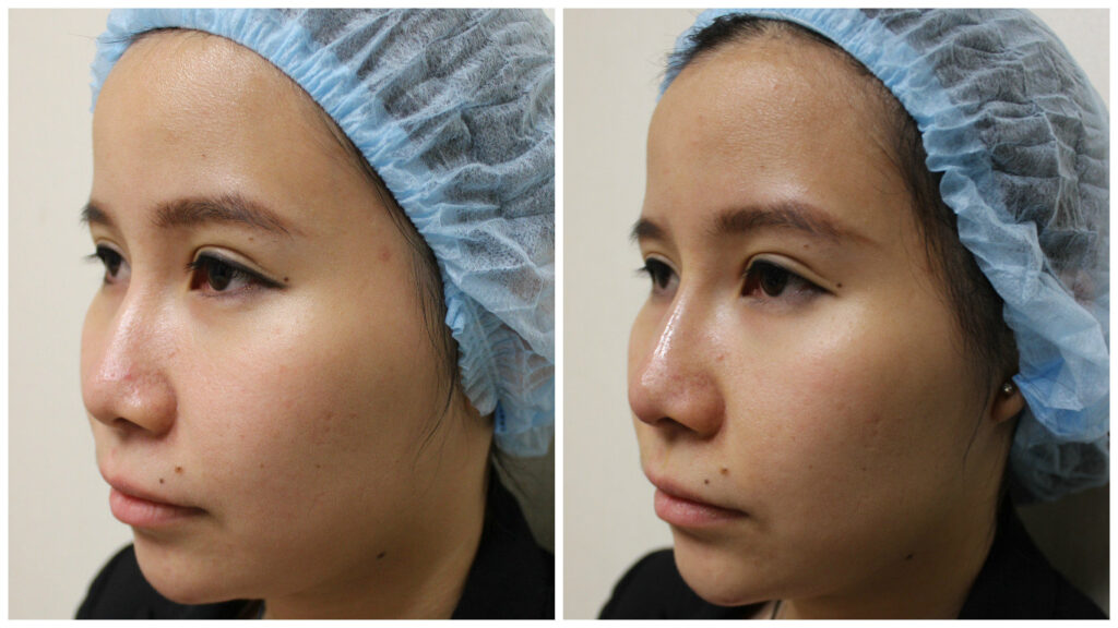 Phân biệt nâng mũi S-Line và L-Line, dáng mũi phù hợp 9 What are Nose Thread lifts? - SG BEAUTY BLOG