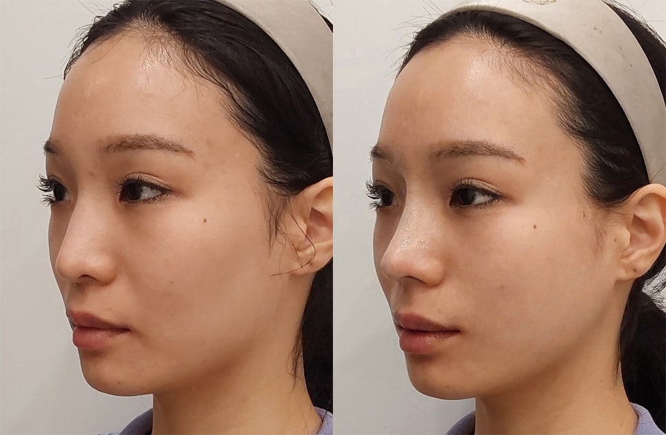 Quy trình nâng mũi cấu trúc an toàn và chuẩn y khoa 14 Non-Surgical Nose Enhancement in Seoul: Nose Thread Lift vs Filler — Guide for Medical Travelers - PangPang