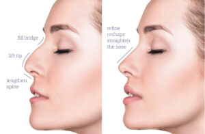 Nose Thread Lift - Non-Surgical Rhinoplasty Solution