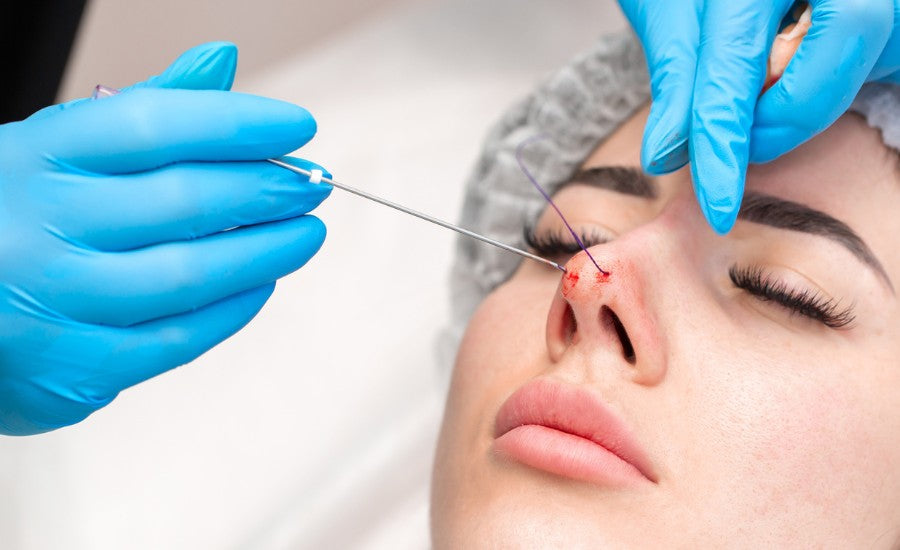 So sánh cắt và cuộn cánh mũi, tư vấn từ chuyên gia 13 Long-Term Results of a Nose Thread Lift: A Two-Year Perspective – diaminyaesthetics