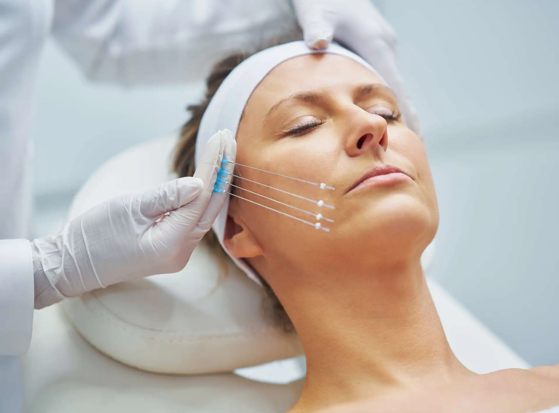 So sánh nâng mũi cấu trúc và thường, lựa chọn tốt nhất 10 Hiko Nose Lift Threads Vs Fillers | Perfect Doctors Clinic