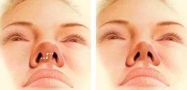 So sánh sụn tự thân và sụn nhân tạo, lựa chọn tối ưu 12 Rhinoplasty Procedure Steps | American Society of Plastic Surgeons