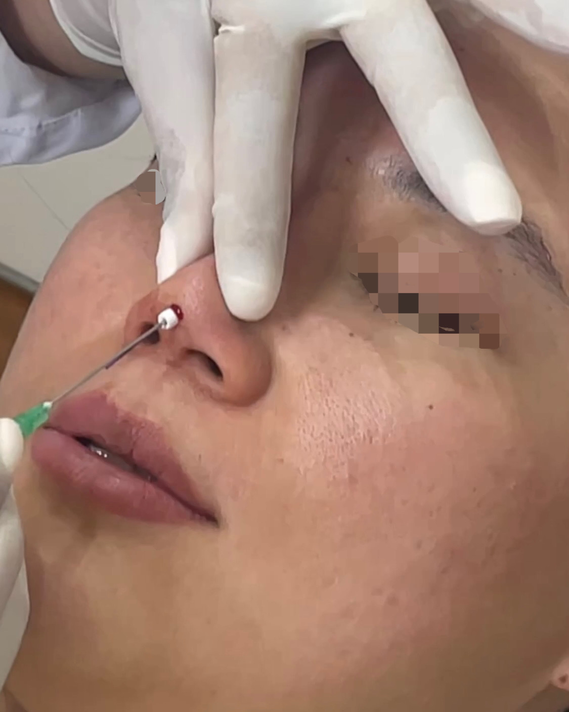 Thu gọn cánh mũi có để lại sẹo không, tư vấn chuyên sâu 15 Hiko Nose Threads: The Future of Nose Enhancements