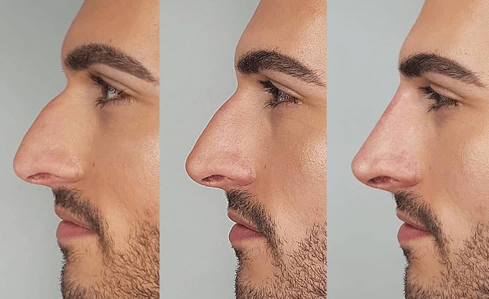 Thu gọn cánh mũi có để lại sẹo không, tư vấn chuyên sâu 16 What Is a Nose Thread Lift? - Linia Skin Clinic