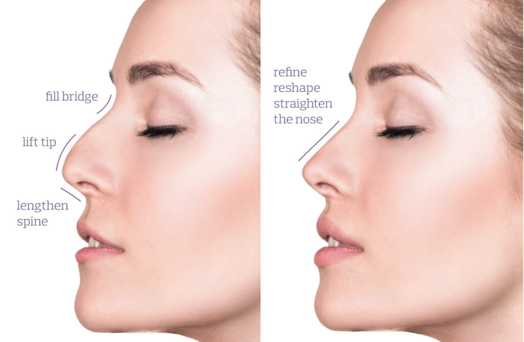 Thu gọn cánh mũi có để lại sẹo không, tư vấn chuyên sâu 9 Nose Thread Lift - Non-Surgical Rhinoplasty Solution
