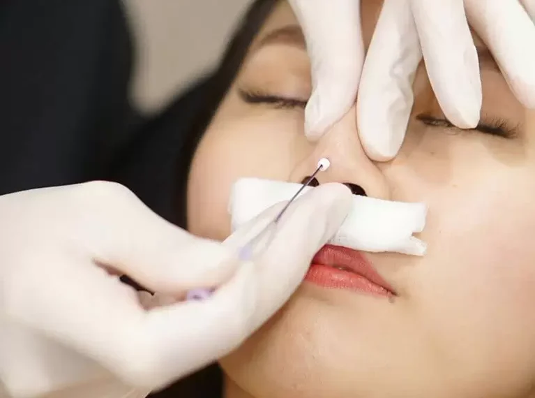 Thu gọn cánh mũi có để lại sẹo không, tư vấn chuyên sâu 13 Non-Surgical Nose Augmentation: Understanding the Nose Thread - NextMed Clinic