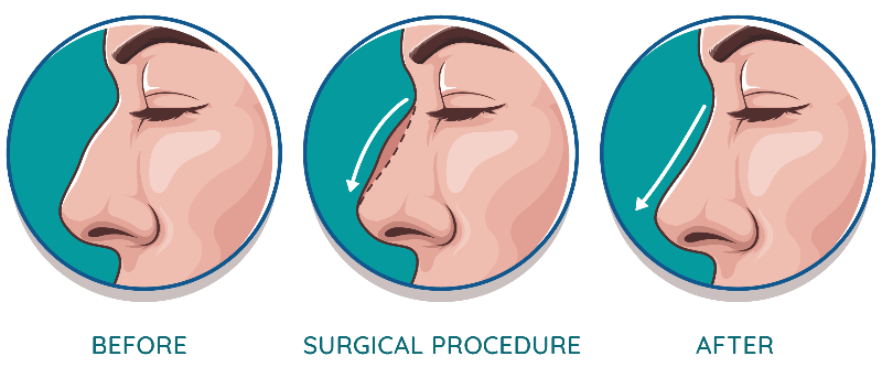 Thu gọn đầu mũi ảnh hưởng khứu giác không, giải đáp 13 Rhinoplasty: Sculpt Your Nose with Expert Surgical Precision